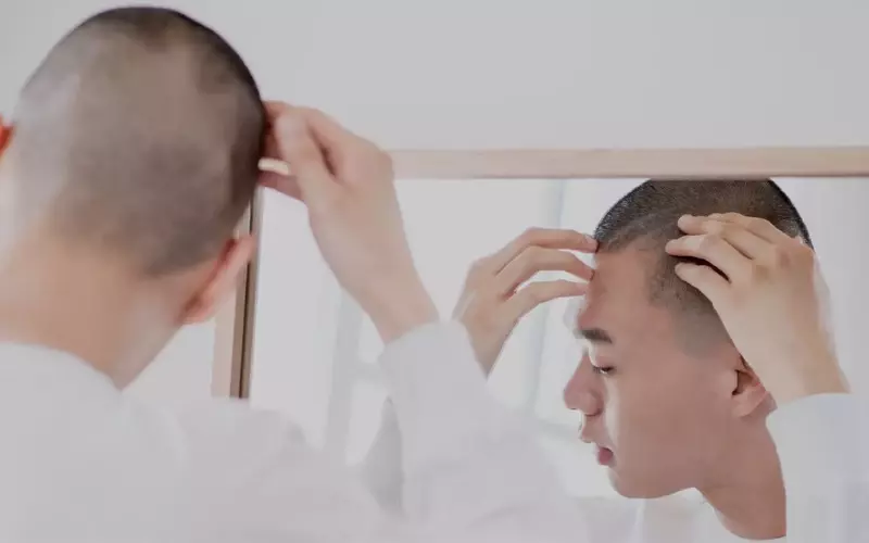 모발이식, 제대로 알아보기: 수술 전부터 관리까지