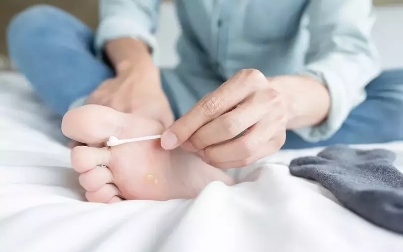 무좀 치료법, 뭐가 맞을까: 바르는 약부터 레이저까지